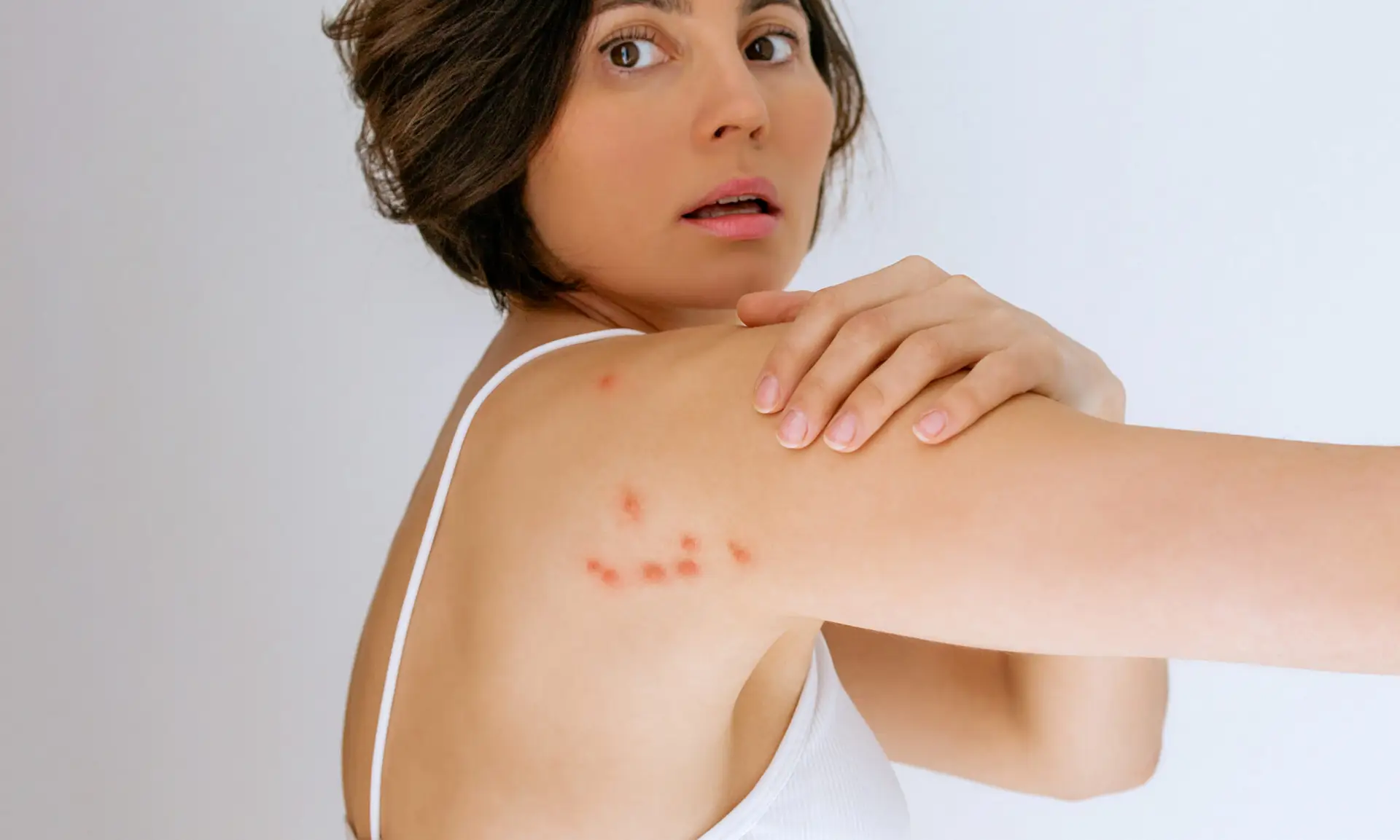 Bed bug bites on shoulder showing the physical evidence that drives psychological distress