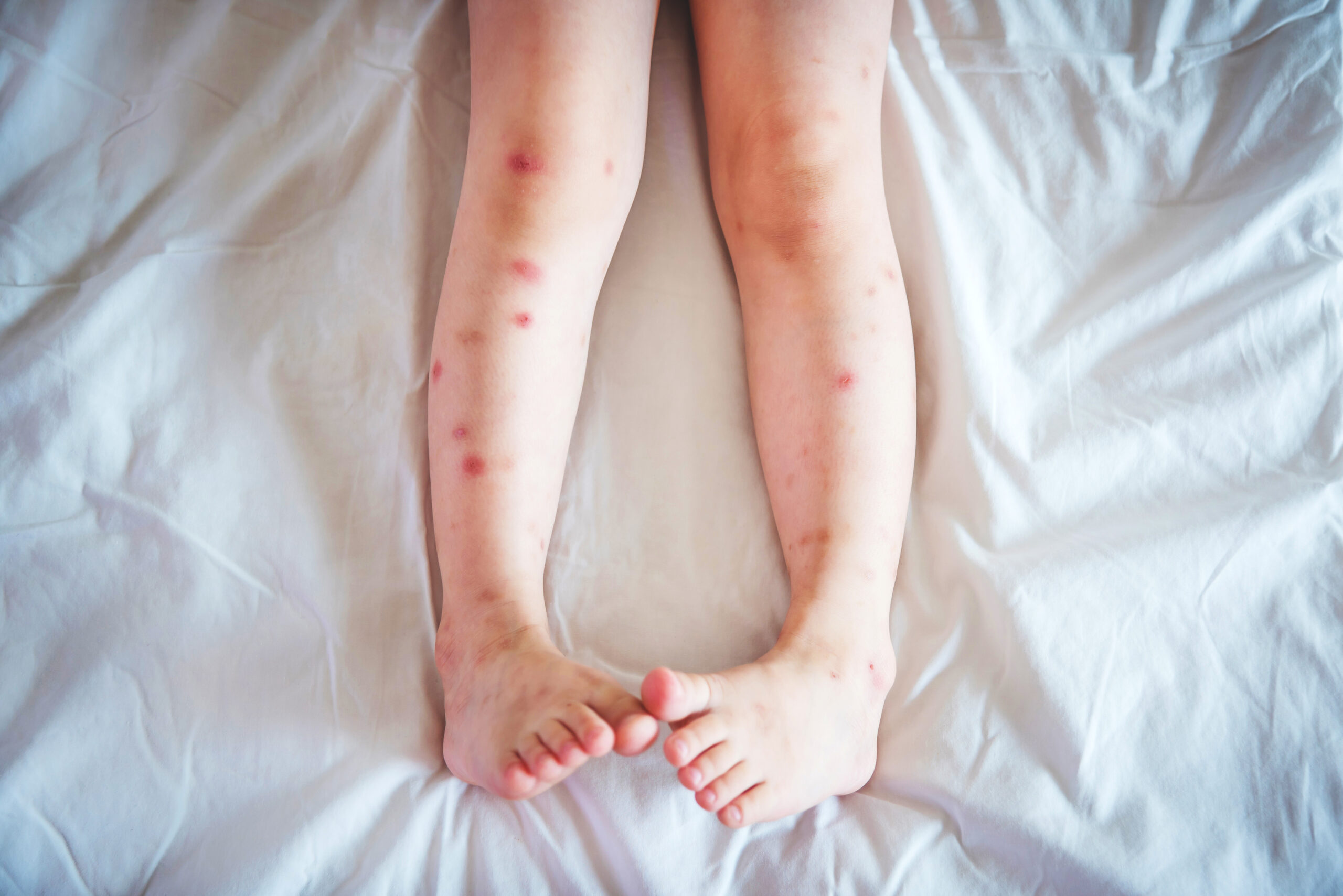 Red itchy bed bug bites on legs in linear pattern