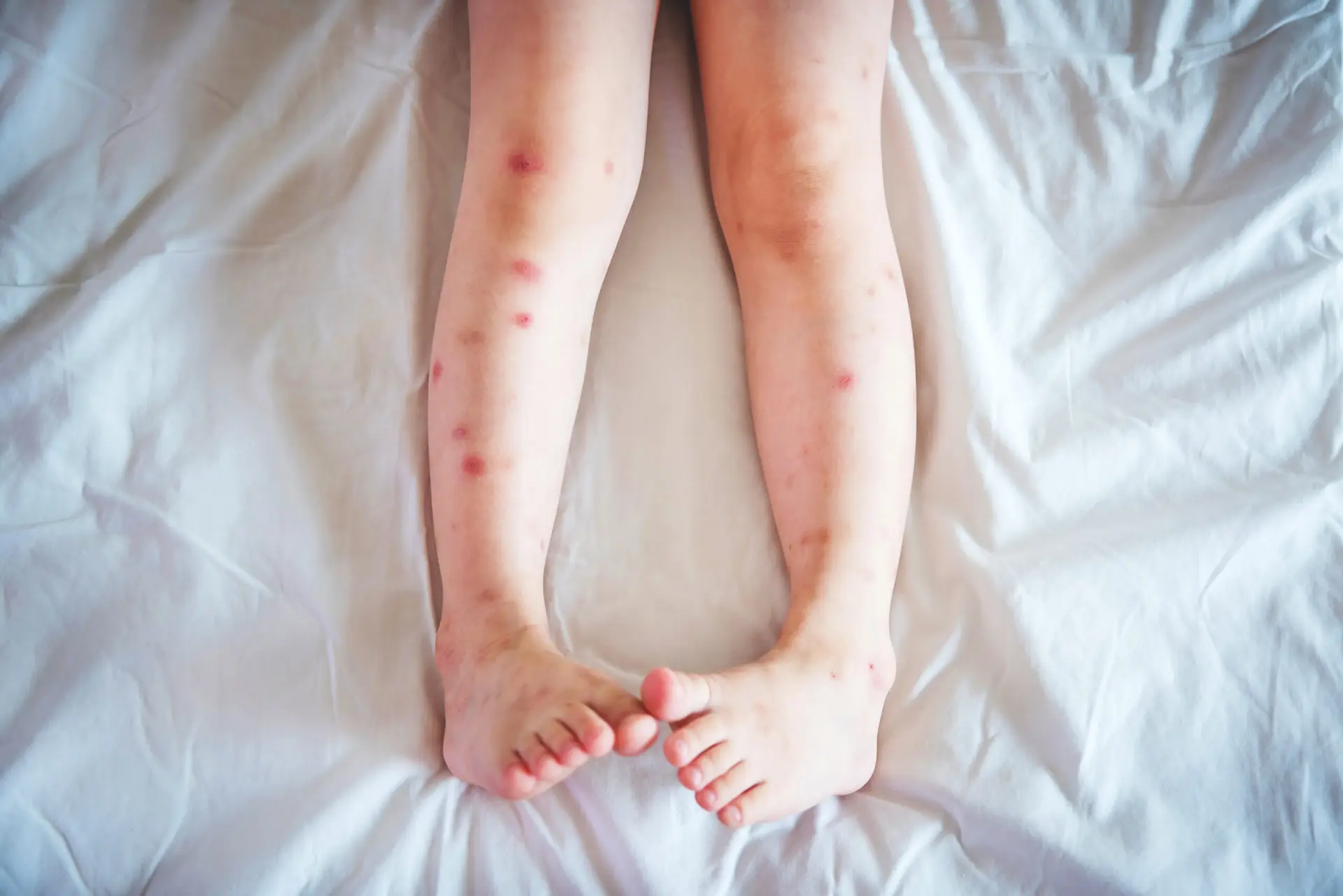 Red itchy bed bug bites on human legs showing characteristic pattern